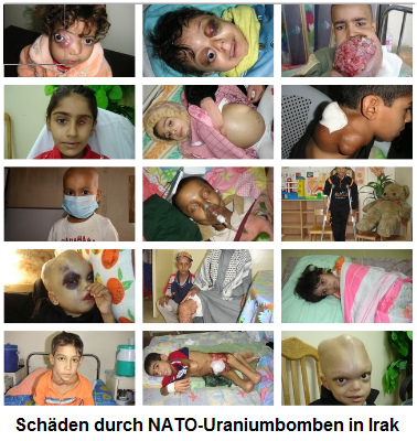 Deformierte Kinder im Irak durch
                                NATO-Uraniummunition