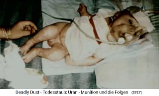 Child with radioactive NATO
damage from nuclear missile
("uranium ammunition") 04 Child with radioactive NATO damage
from nuclear missile ("uranium
ammunition") 04