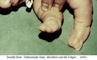 Child with radioactive NATO
damage from nuclear missile
("uranium ammunition"),
deformed feet Child with
radioactive NATO damage from nuclear
missile ("uranium
ammunition"), deformed feet