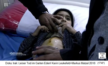 The new heart
                                    center of Nasiriya - a boy had a
                                    heart operation and his scar is
                                    controlled