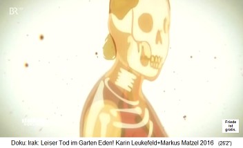 Cartoon: Uranium destroys
bones and the bone marrow, provoking
leukemia Cartoon: Uranium
destroys bones and the bone marrow,
provoking leukemia