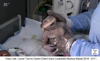 Basra (Irak),
                das Kinderkrankenhaut mit Frhgeburt mit einem offenen
                Hirn