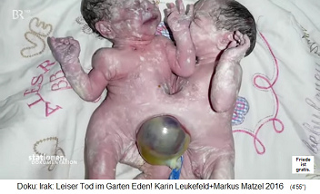 Irak: Missbildung mit 2
                                  Neugeborenen, die zusammengewachsen
                                  sind mit aussenstehender Harnblase