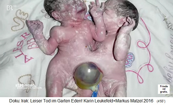 Iraq: Malformation with 2
                                    newborns that have grown together
                                    with an external urinary bladder
