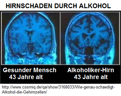 Der
                    Vergleich eines gesunden Gehirns und eines Gehirns
                    eines Alkoholikers mit 43 Jahren - beim Alkoholiker
                    ist das Gehirn nur noch ein Gerippe Der Vergleich eines
                    gesunden Gehirns und eines Gehirns eines
                    Alkoholikers mit 43 Jahren - beim Alkoholiker ist
                    das Gehirn nur noch ein Gerippe