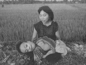 Vietnam war: Agent Orange victim.