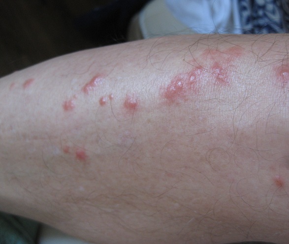 Picaduras en la pierna derecha en la tibia 02