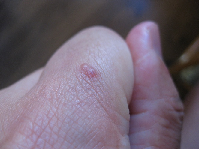 Picadura como ampolla en el
                  dedo �ndice de la mano izquierda 02