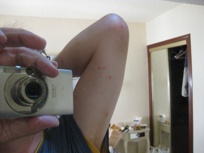 Picaduras en el brazo derecho
                  superior en la parte trasera