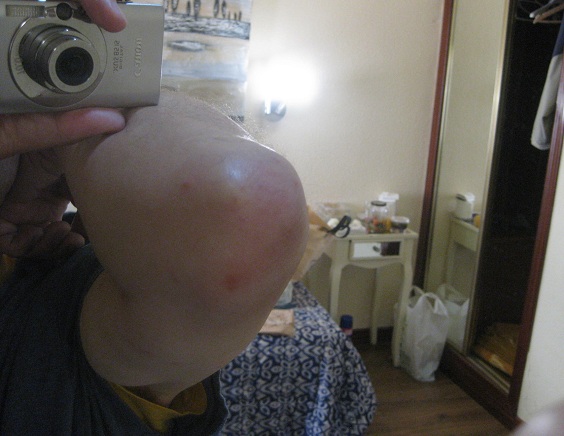 Picaduras en el brazo derecho en la regi�n
                  del codo