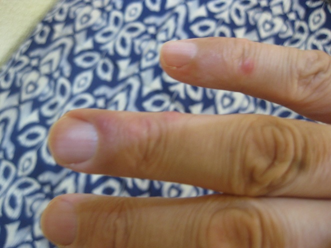 Picaduras en la mano derecha: dedo
                  peque�o y dedo anular