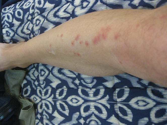 Picaduras en la pierna derecha en la tibia 04