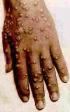A hand
infected by smallpox A hand
infected by smallpox