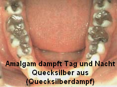 Amalgam
dampft Tag und Nacht hochgiftige Quecksilberdämpfe
aus Amalgam dampft Tag und Nacht
hochgiftige Quecksilberdämpfe aus