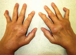 Artritis reumatoida (aquí con
articulaciones básico de dedos hinchadas, con
nudos reumáticos a las articulaciones de los
dedos y con meñiques deformados) es diverso
según el grupo sanguíneo Artritis reumatoida
(aquí con articulaciones básico de dedos
hinchadas, con nudos reumáticos a las
articulaciones de los dedos y con meñiques
deformados) es diverso según el grupo sanguíneo