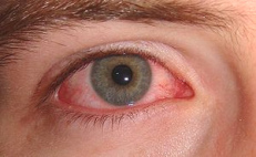 Según Dr. Peter D'Adamo se puede curar la
conjuntivitis con ruedas de tomates Según
Dr. Peter D'Adamo se puede curar la
conjuntivitis con ruedas de tomates