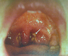 Mononukleosis aparece ms con el grupo
                        sanguneo 0.