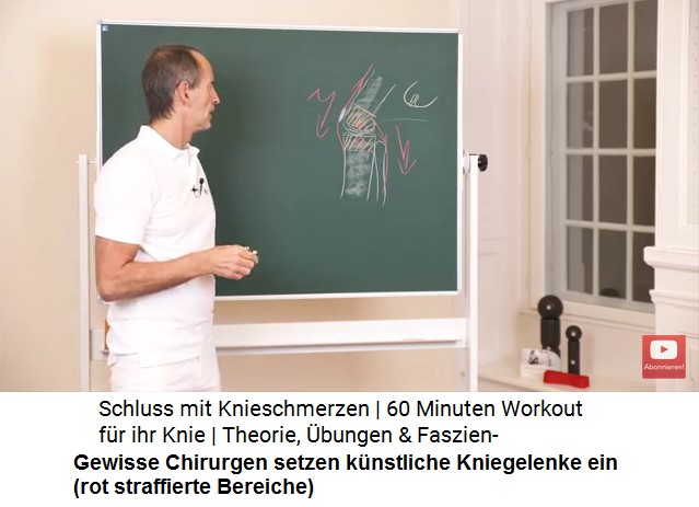 Knstliches
                        Kniegelenk, Schema: Gewisse Chirurgen setzen
                        knstliche Kniegelenke ein (rot straffierte
                        Bereiche)