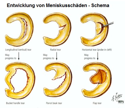 Die
                      Entwicklung von Meniskusschden, Schema