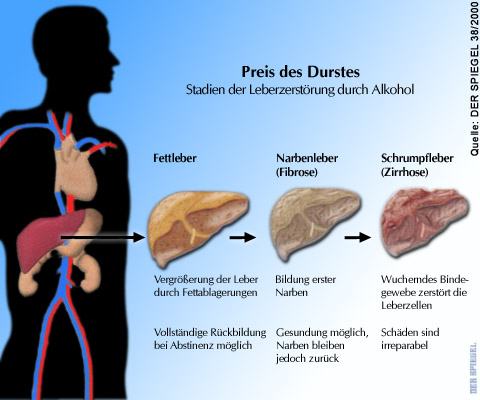 Grafik:
                  Fettleber - Narbenleber - Schrumpfleber durch Alkohol
