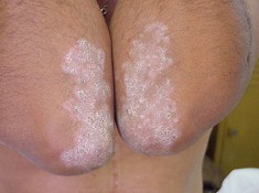 Psoriasis heilt mit Borax