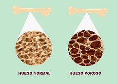 Osteoporosis cura con brax