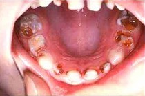 Caries
                      es reducica con brax